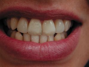 Zahnästhetische Behandlung des Zahnarztes Gojnic in Bremen